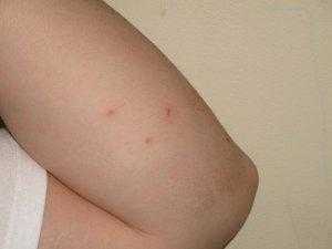 Как выглядят укусы клопов на коже человека: признаки, размеры, симптомы, фото