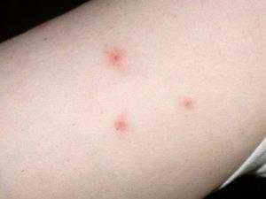 Как выглядят укусы клопов на коже человека: признаки, размеры, симптомы, фото