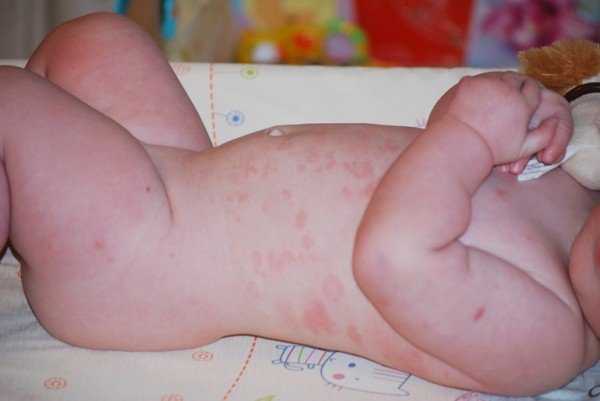 Аллергия на укусы комаров