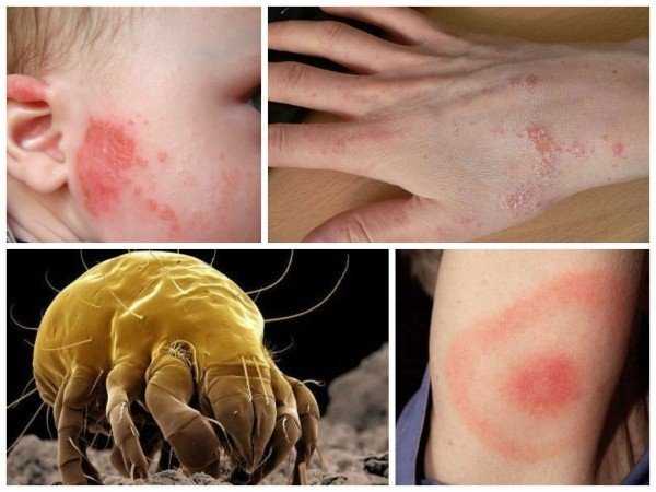 Чем опасны укусы постельных клопов и какие болезни они переносят