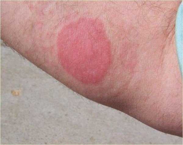 Аллергия на отраву от клопов thumbnail