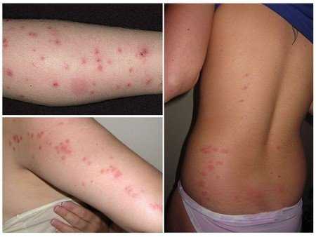 Аллергия на теле от вшей thumbnail