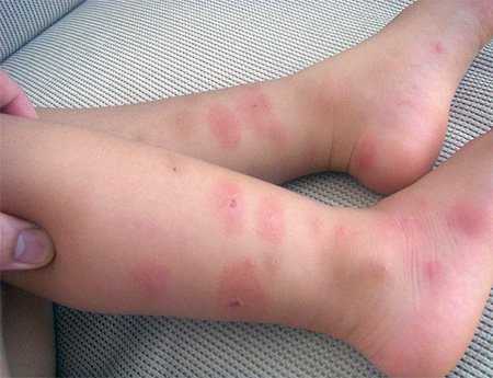 Аллергия на укусы клопов у детей лечение thumbnail