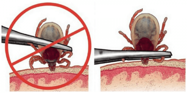 Чем обработать укус клеща — необходимые действия при атаке паразита