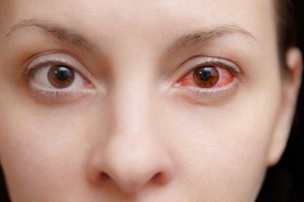 Глазной клещ — описание, симптомы заражение, осложнения, эффективное лечение 