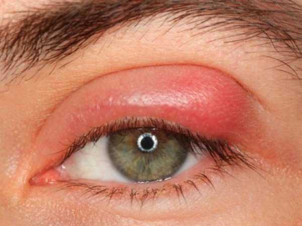 Глазной клещ — описание, симптомы заражение, осложнения, эффективное лечение 