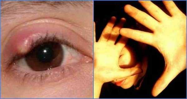 Симптомы и лечение глазного клеща