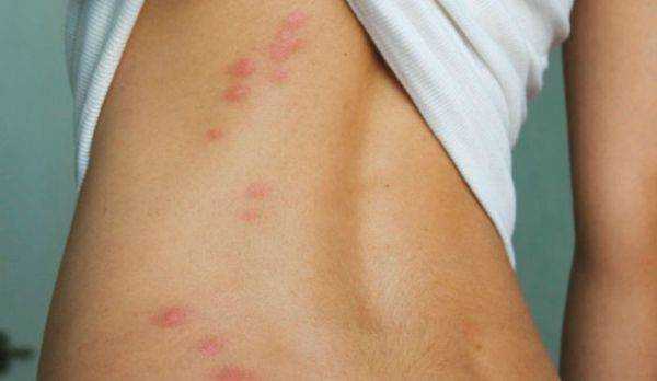 Чем лечить аллергию на укусы клопов у детей и взрослых