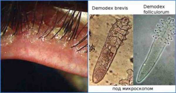 Клещ демодекс на ресницах: причины, симптомы и лечение