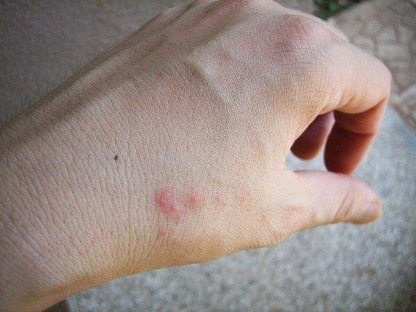 Узнаем кусаются ли тараканы: в каких случаях и кого чаще могут укусить, чем опасны укусы для людей, фото