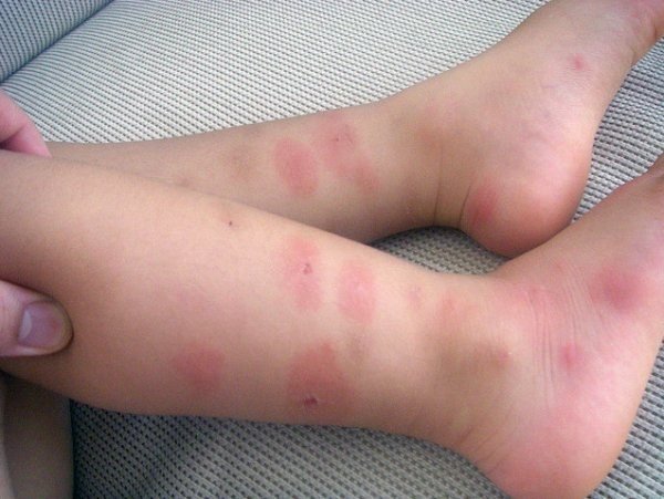 Чем вызвана аллергия на клопов и возможно ли ее вылечить?